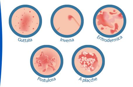 cos-e-la-psoriasi-forme-di-psoriasi-ducray