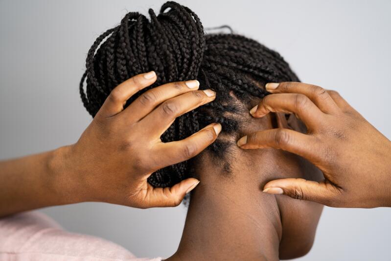 what-is-traction-alopecia-ducray