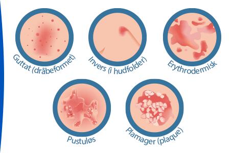 hvad-er-psoriasis-typer-af-psoriasis-ducray