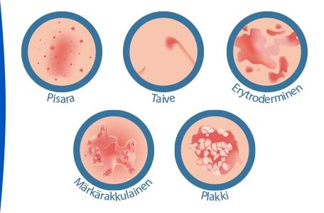 mika-on-psoriasis-psoriaasin-muotoja-ducray