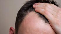 DU_HAIRLOSS_MAN