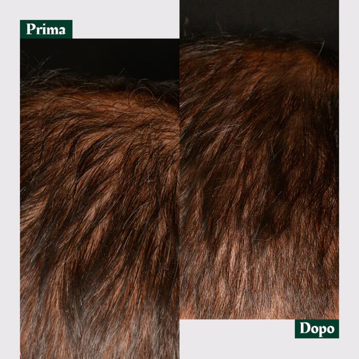 Risultati Trattamento contro la caduta dei capelli progressiva
