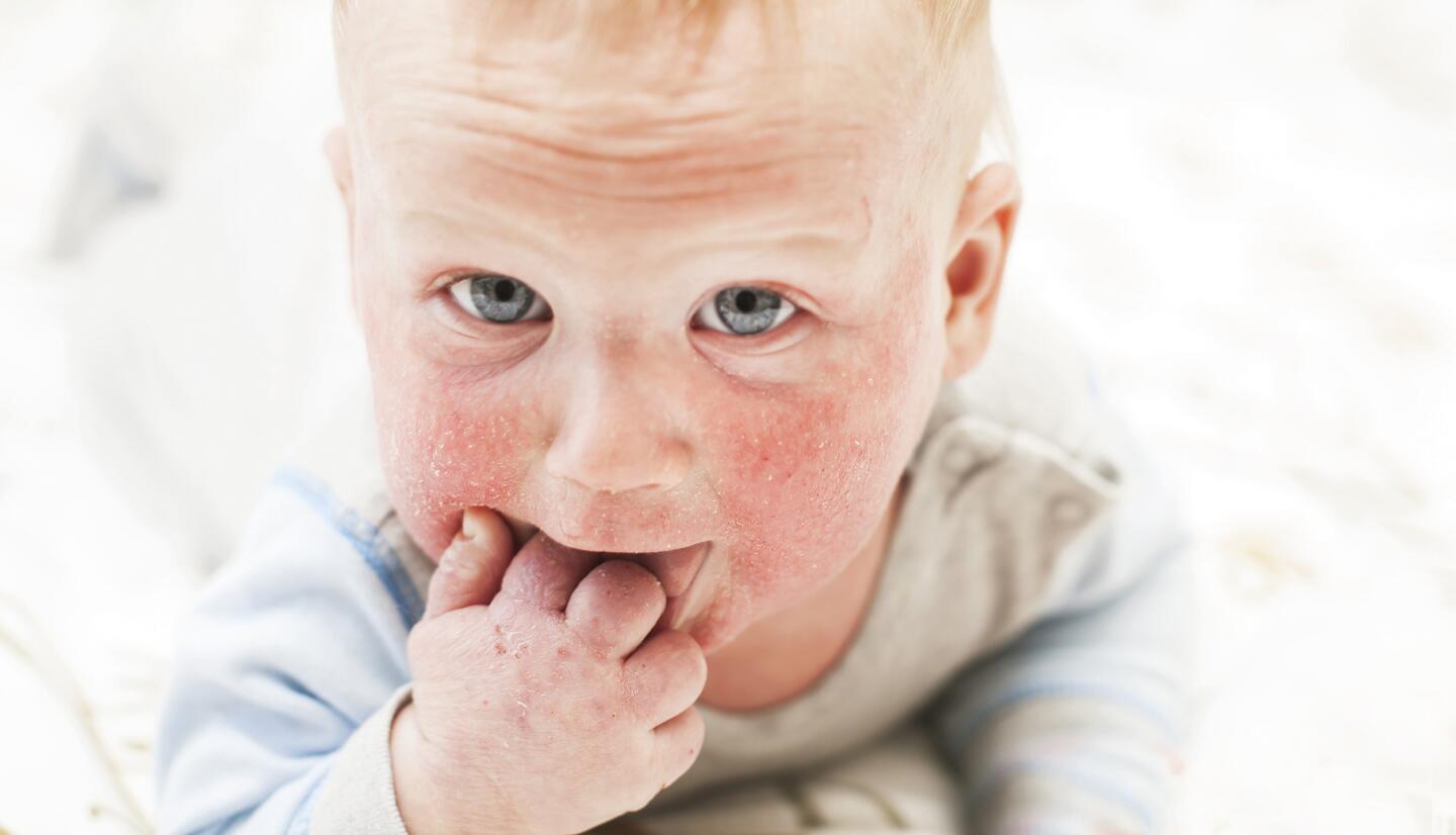 Costra láctea (dermatitis seborreica bebés)