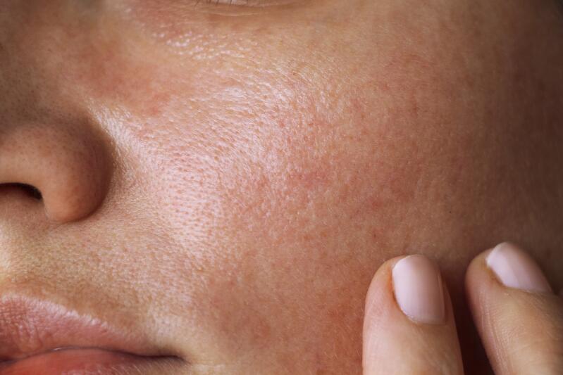 Sebum top