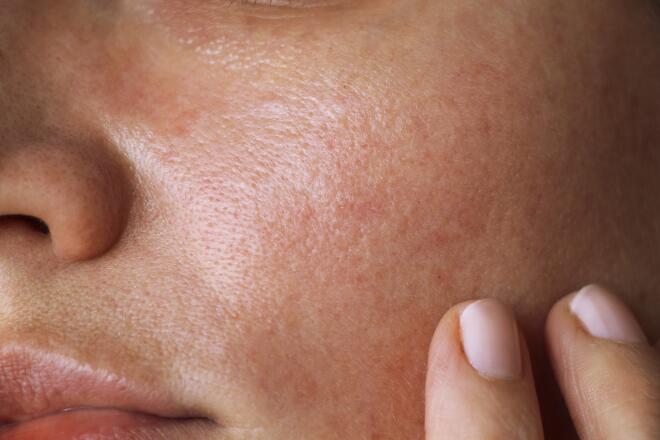 manchas-de-acne-desvanece-esas-secuelas-ducray-upper-image