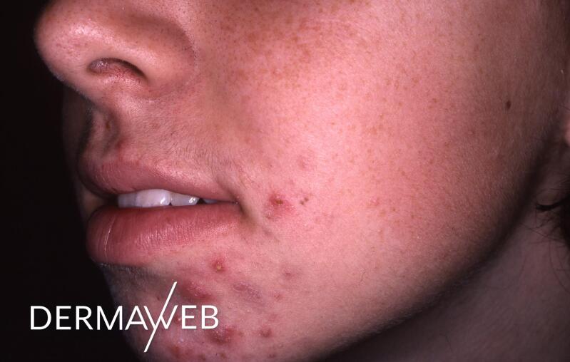 l-acne-inflammatoire-symptomes-et-traitement-ducray