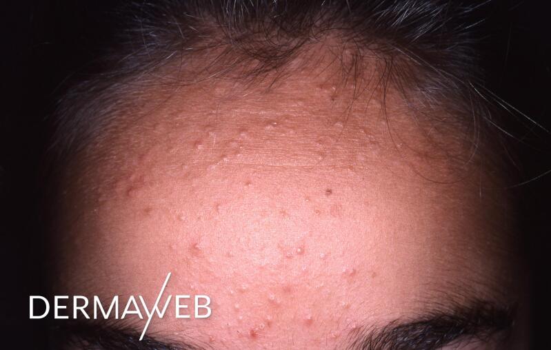 l-acne-retentionnelle-causes-et-solutions-ducray