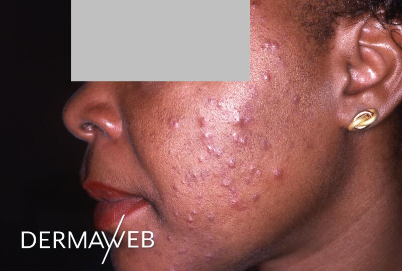 L'acné nodulaire (kystique) : symptômes et traitement ...