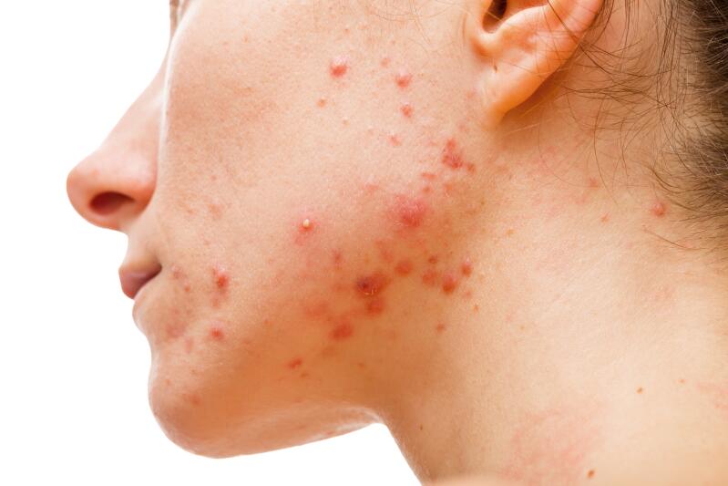 hormonal-acne-ducray