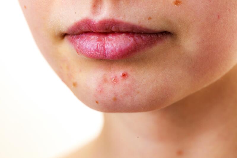 acne-on-the-chin-ducray