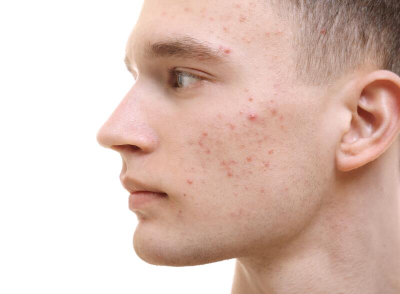 L’acné sur le visage Laboratoires Dermatologiques Ducray
