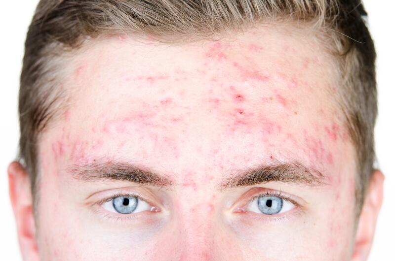L’acné sur le front Laboratoires Dermatologiques Ducray