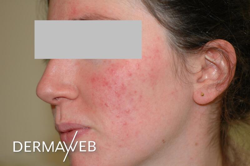 acne-ou-rosacee-quelle-difference-ducray