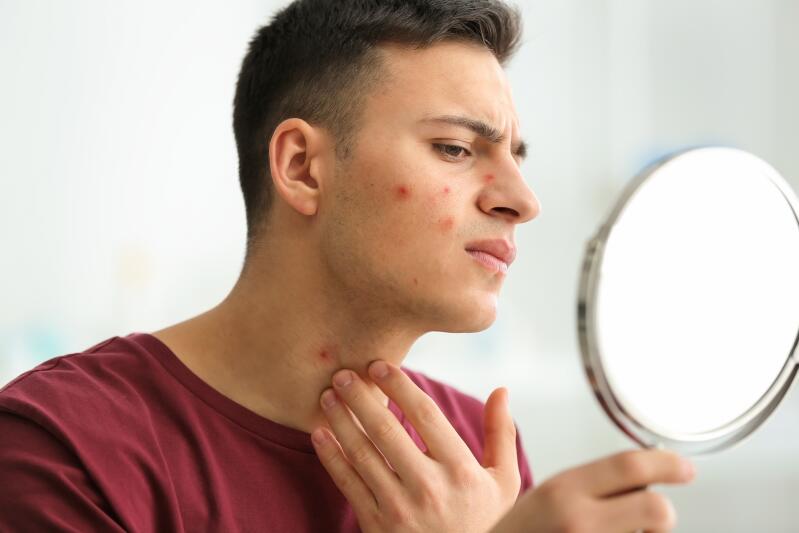 l-acne-chez-l-homme-causes-et-traitements-ducray