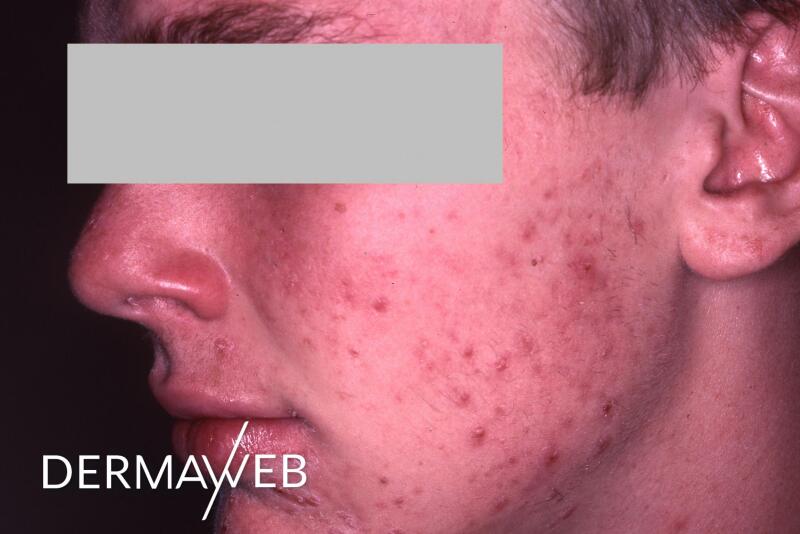 l-acne-severe-consequences-et-solutions-ducray