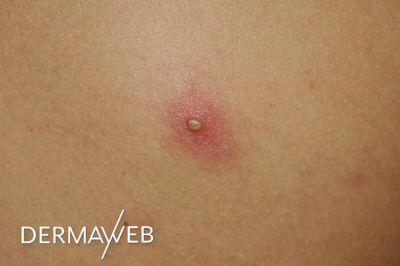 acne-spots-what-are-they-ducray