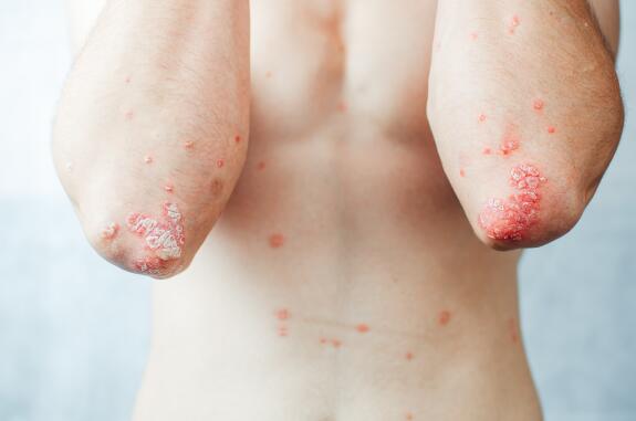 Comment j'ai vaincu mon Psoriasis sans aucun traitement