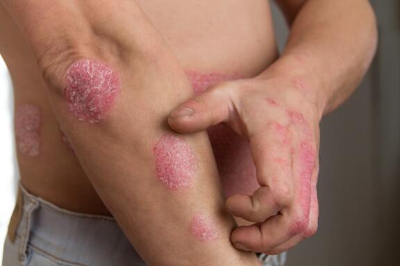 psoriasis-causes-symptomes-et-traitement-les-symptomes-du-psoriasis-ducray