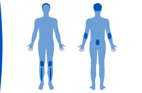 la-psoriasis-los-tratamientos-de-la-psoriasis-ducray