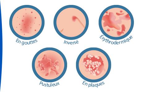 ce-este-psoriazisul-forme-de-psoriazis-ducray