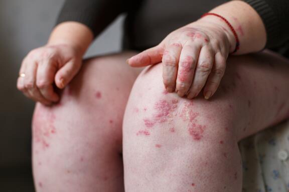 les-symptomes-du-psoriasis-les-plaques-de-psoriasis-le-plus-visible-symptome-ducray