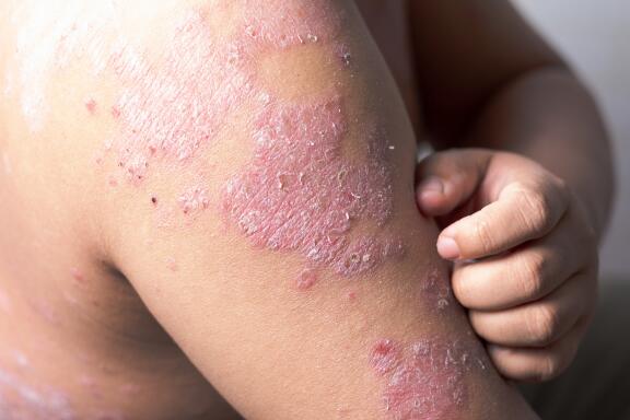the-symptoms-of-psoriasis-itching-related-to-psoriasis-ducray