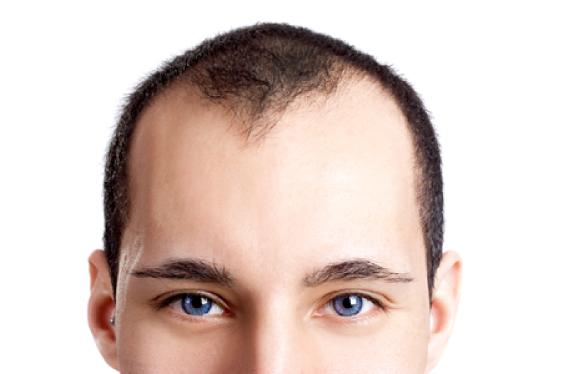 chute-de-cheveux-chez-l-homme-comment-lutter-contre-l-alopecie-ducray