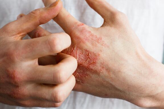 eczema-simptomele-unui-puseu-de-eczem-ducray