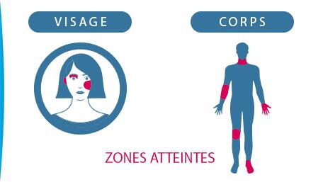 l-eczema-les-zones-atteintes-par-l-eczema-ducray