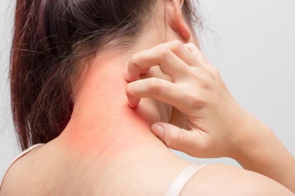 body-eczema-hands-feet-arms-back-face-etc-eczema-on-the-neck-and-nape-of-the-neck-ducray