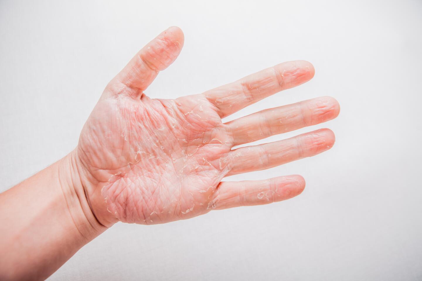 pourquoi-l-eczema-altere-t-il-la-barriere-cutanee-ducray-upper-image