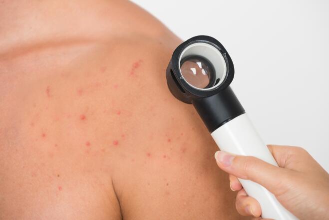 l-acne-presenta-tipologie-diverse-di-sintomi-ducray-upper-image