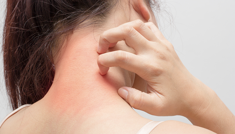 eczema-ce-este-care-sunt-cauzele-i-cum-se-manifest-ducray-upper-image