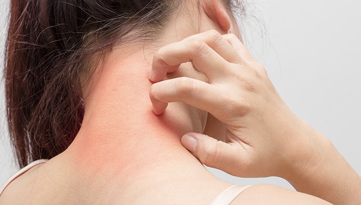 que-es-el-eczema-ducray-upper-image