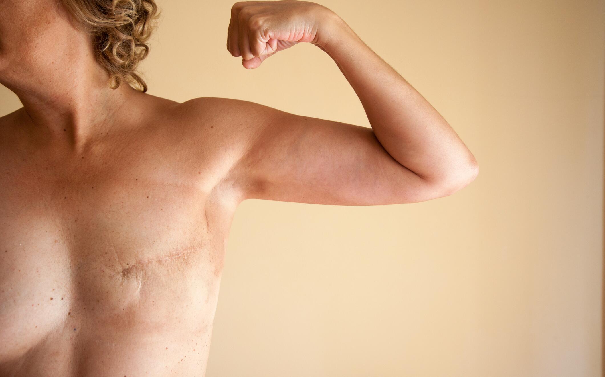 OG_VWOMAN_SHOWING_HER_MASTECTOMY_SCAR_FROM_HER_BREAST_CANCER_OPERATION_ISTOCK_2023
