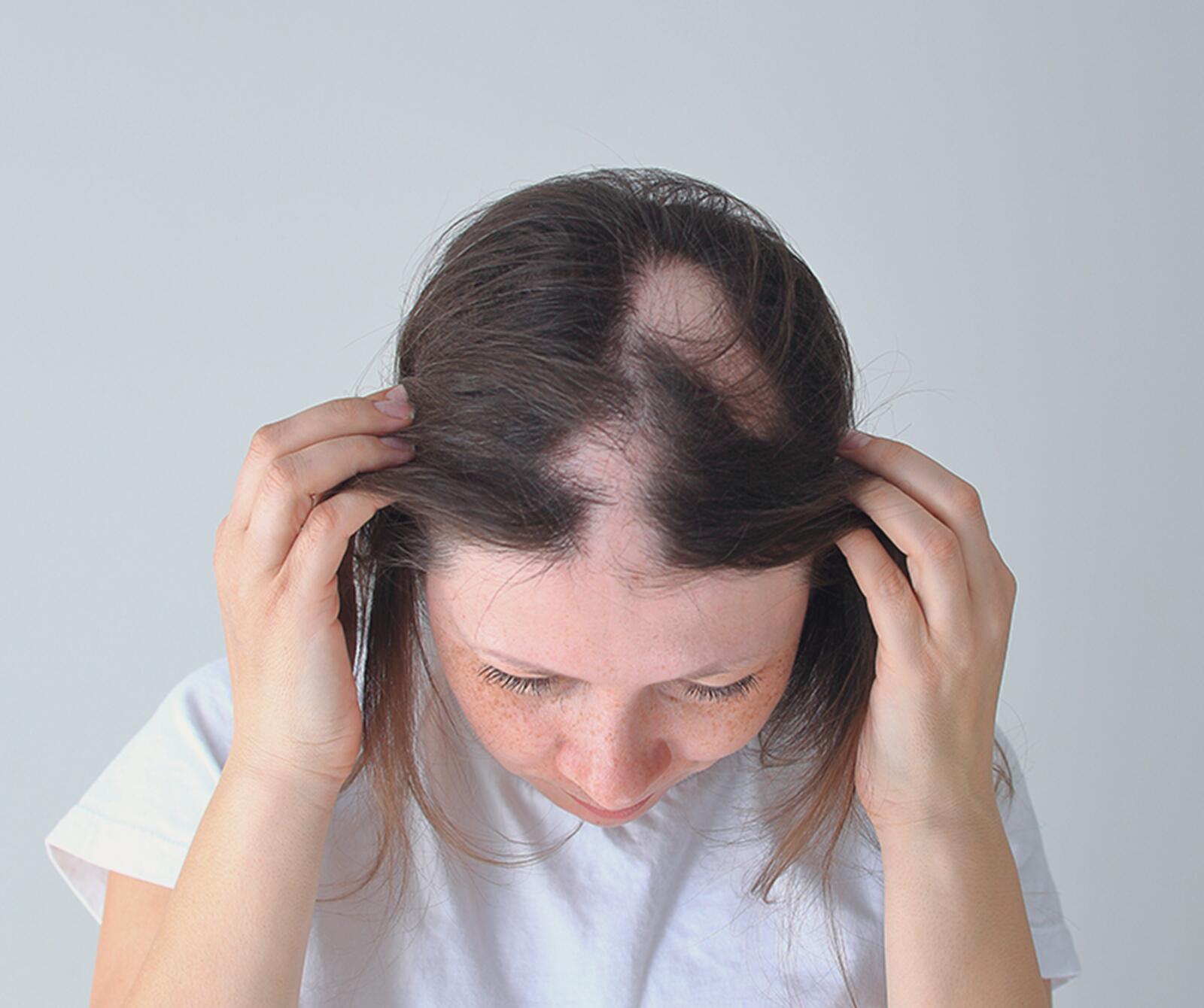Dünne Haare und Haarausfall bei Frauen: Ursachen und Behandlungsmöglichkeiten