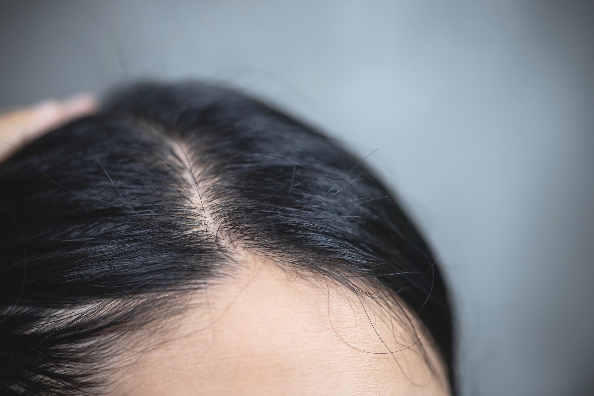 AD_ATOPIC-DERMATITIS_WOMAN-BLACK-HAIR_LARGE_2021