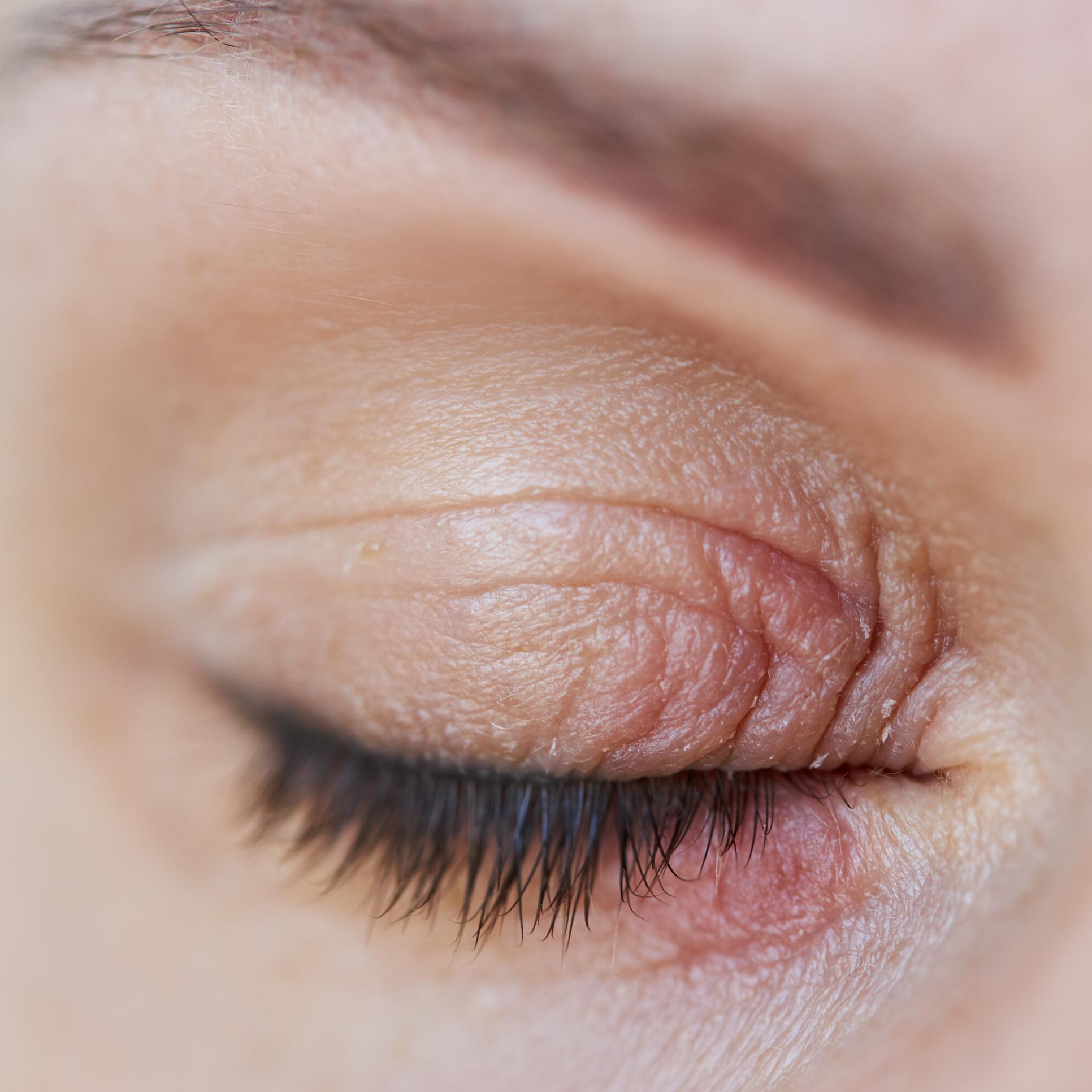 AD_ECZEMA-PAUPIERES_SQUARE_2023