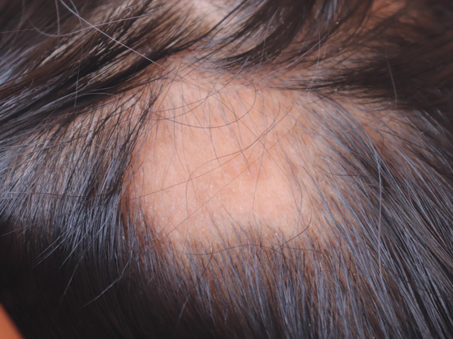 10_Seborrhoisches_Ekzem_Haarausfall_DU_Seborrhoisches_Ekzem_Haarausfall_textmodul1-png