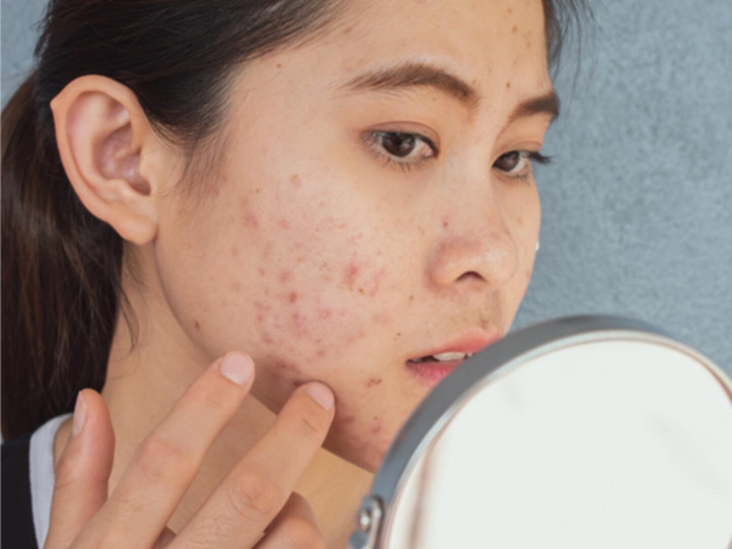 Acne conglobata Eau Thermale Avène