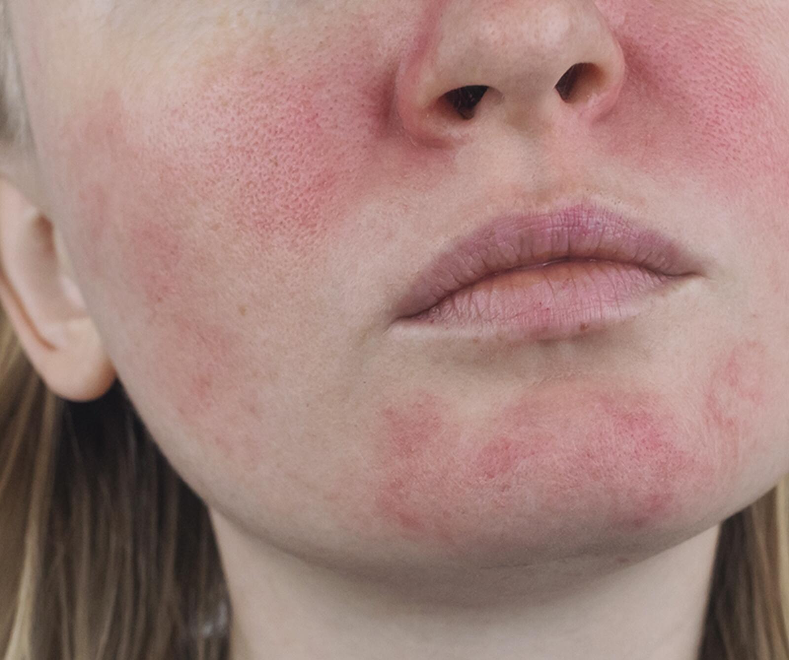 Nase, Augenbrauen, Stirn & Co. – seborrhoische Dermatitis im Gesicht behandeln