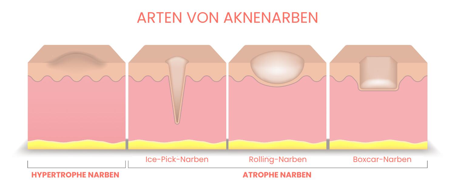 akne-narben-entfernen-arten