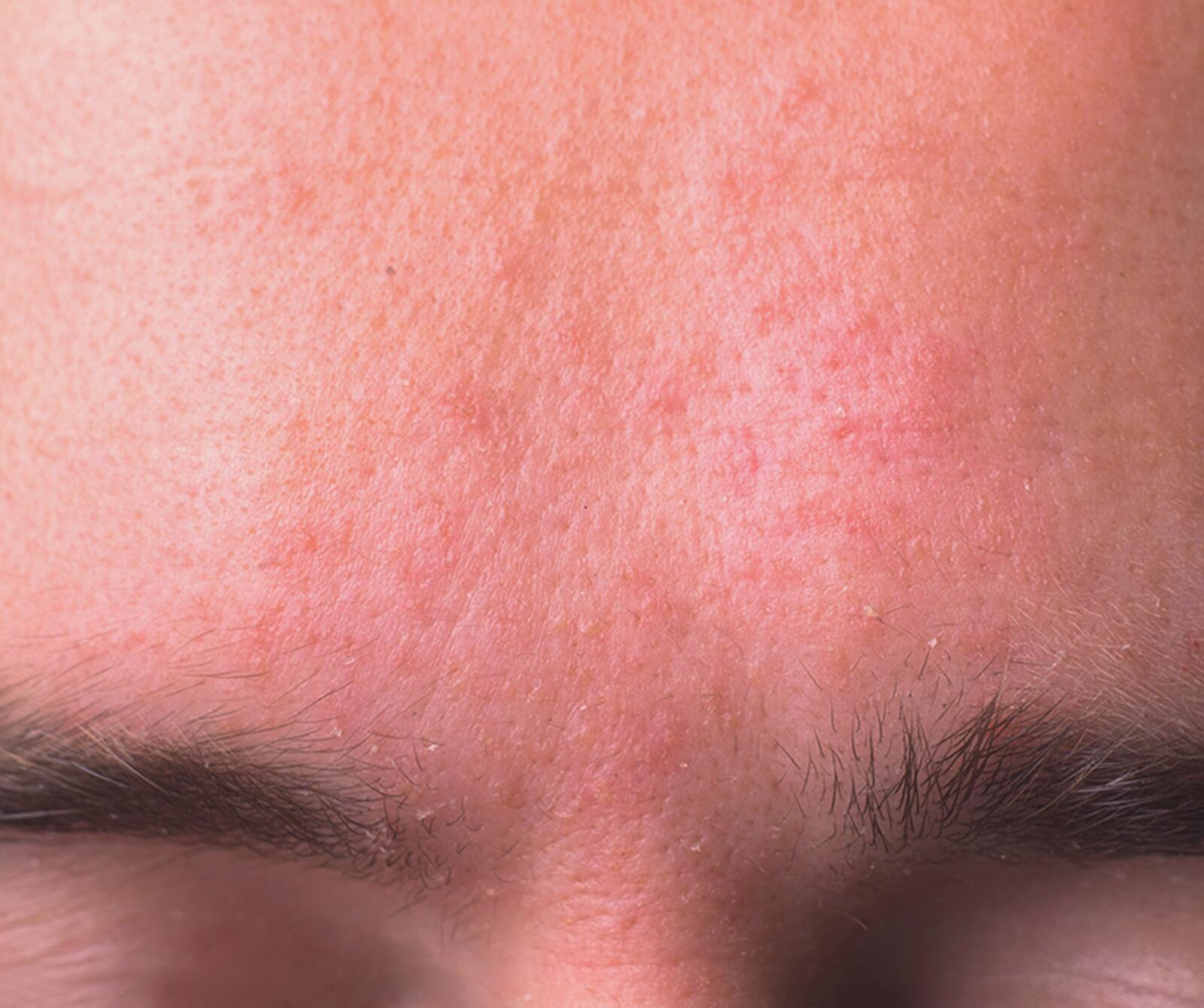 Ursache und Behandlungschancen der Hauterkrankung im Gesicht