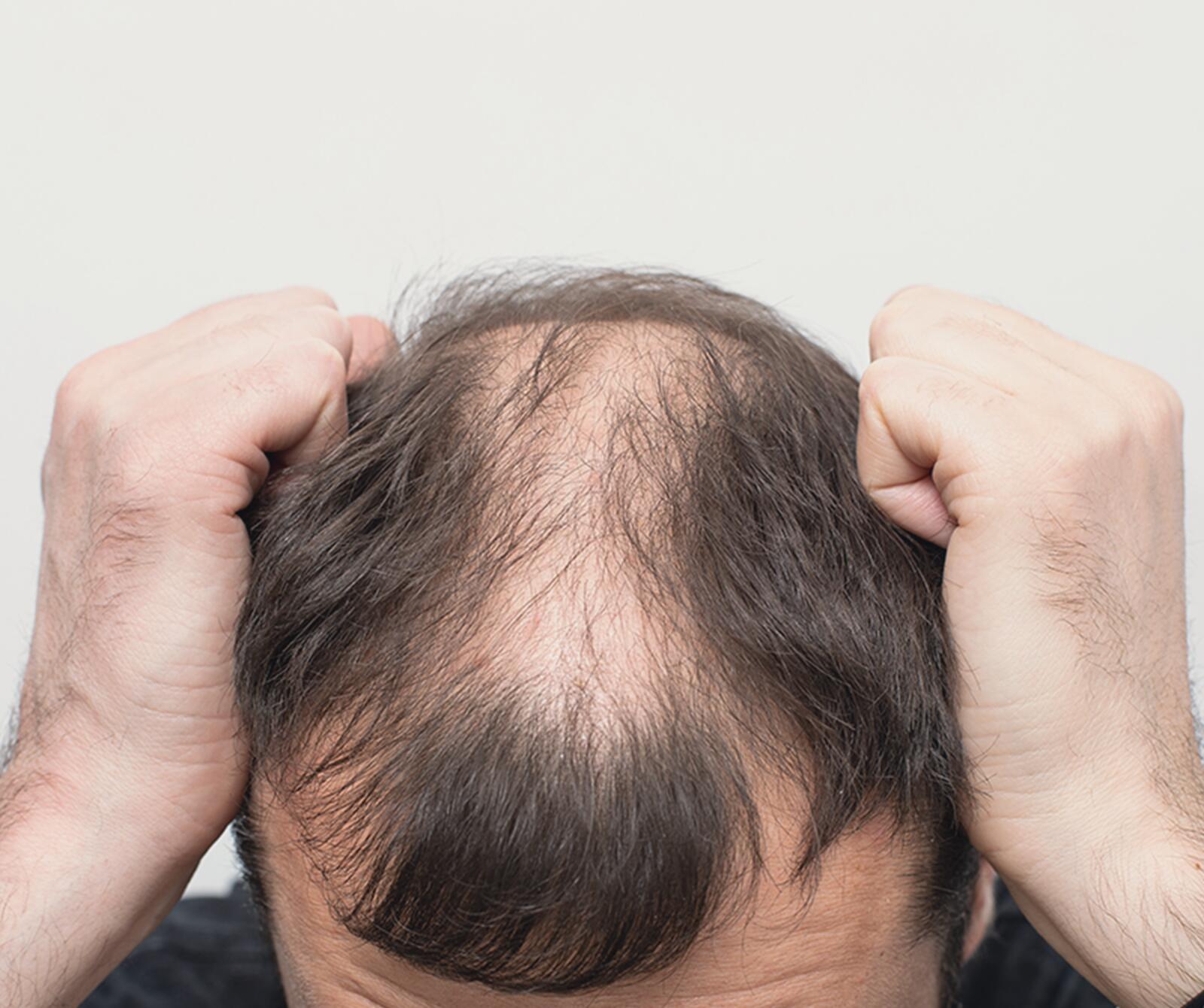 Ursachen und Behandlung von Haarverlust beim seborrhoischen Ekzem