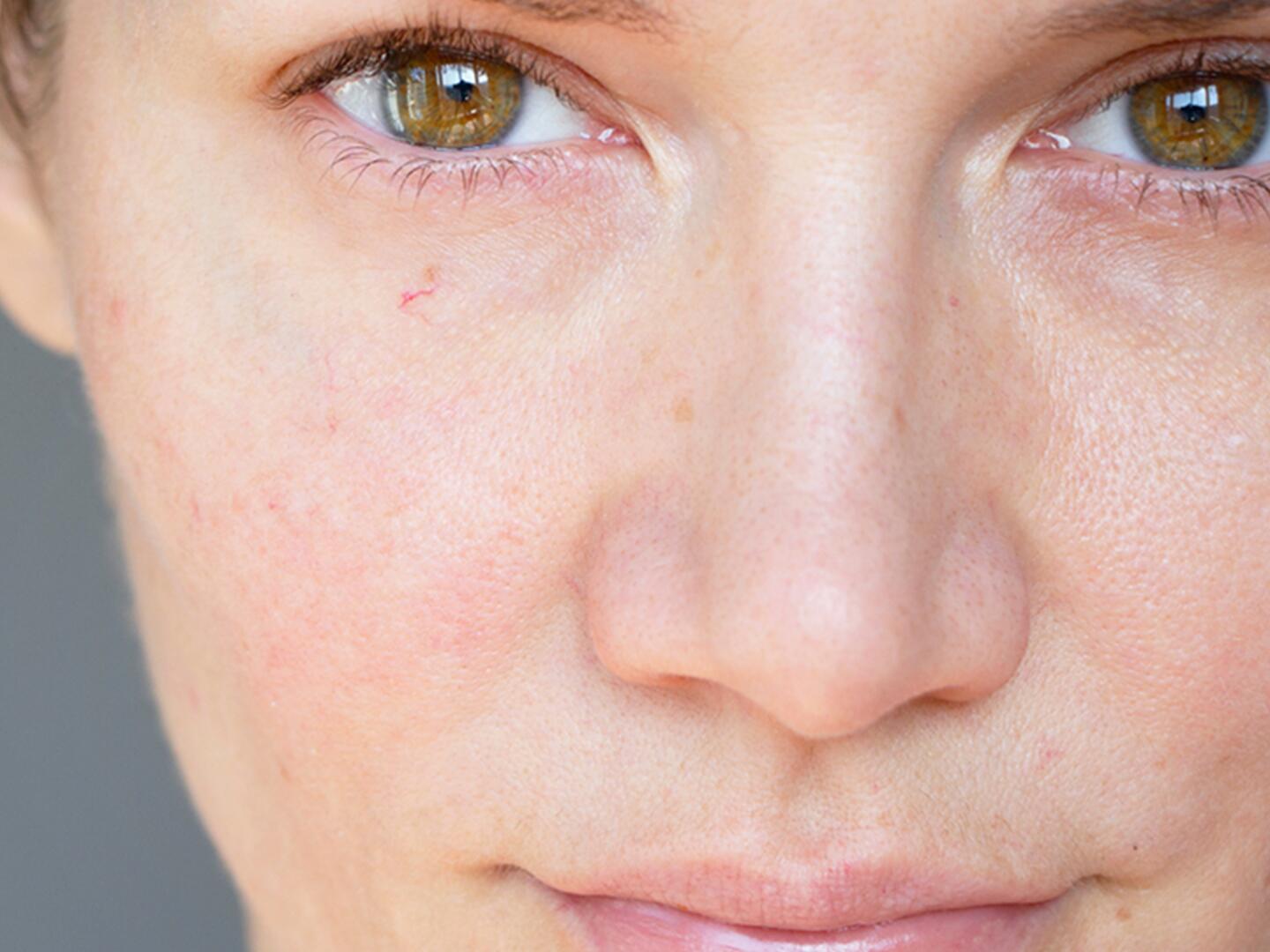 Rote Äderchen im Gesicht | Eau Thermale Avène