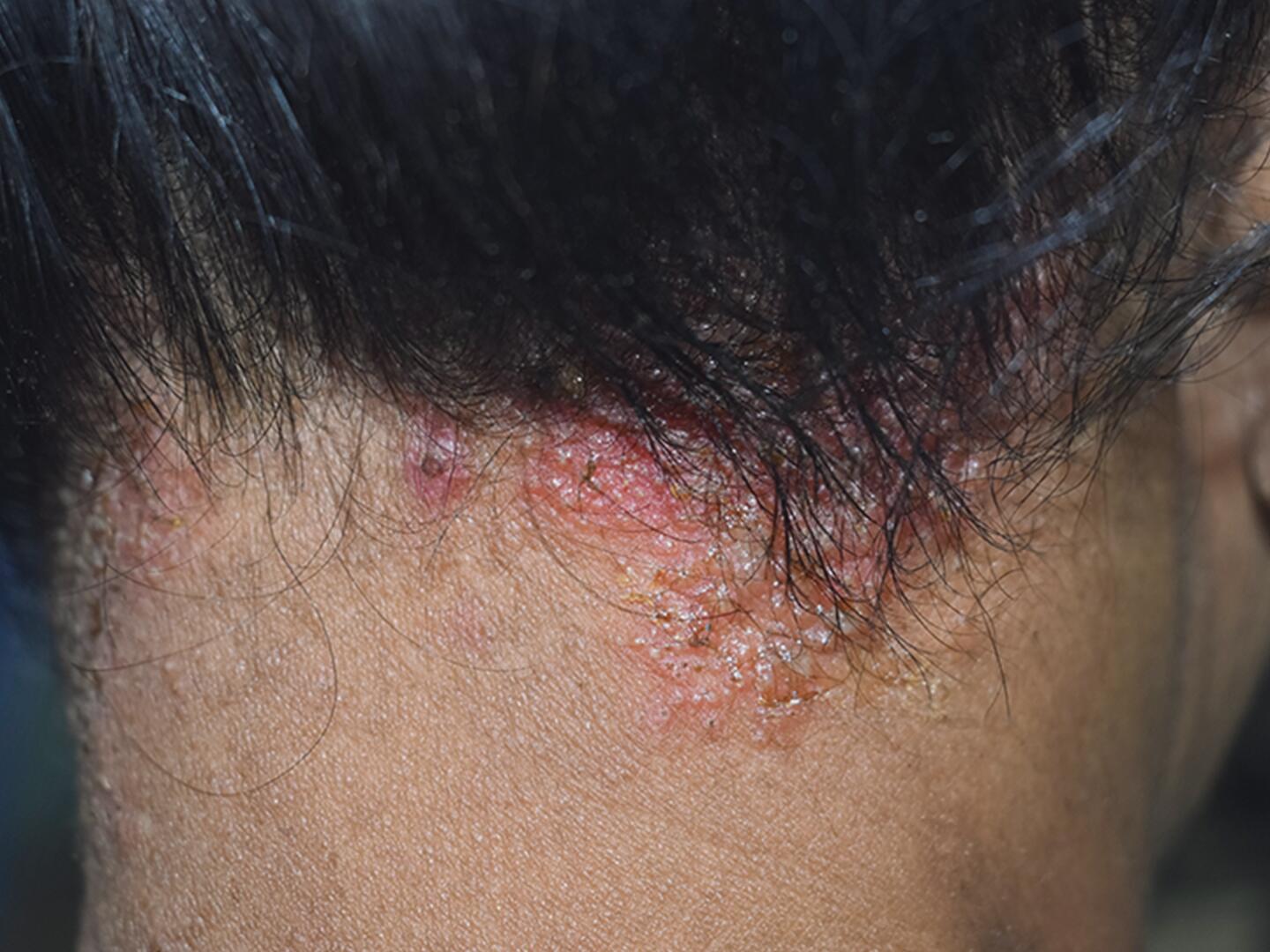 Seborrhoisches Ekzem (seborrhoische Dermatitis) Ducray