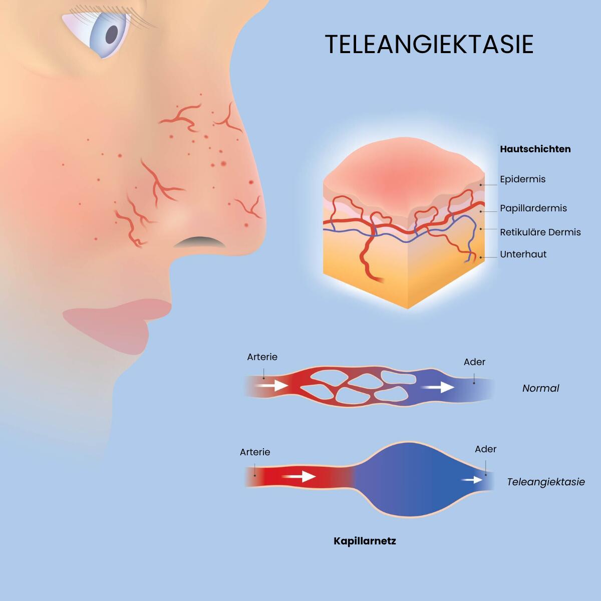 teleangiektasien-definition