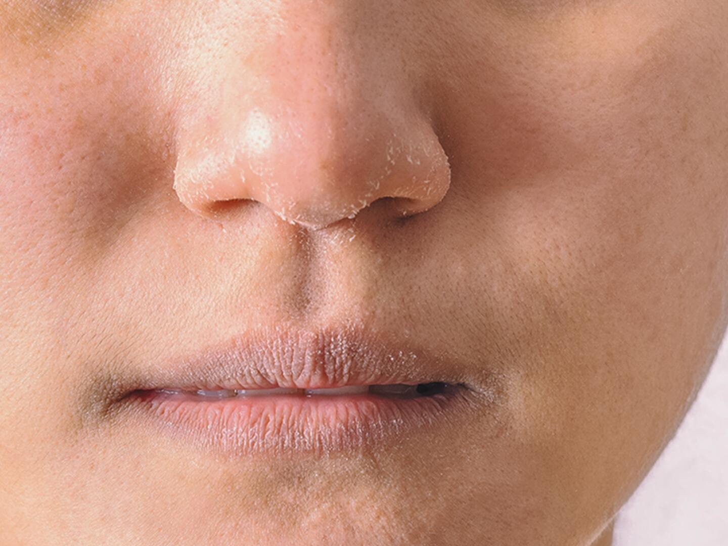 01_Seborrhoisches_Ekzem_Nase_DU_Seborrhoisches_Ekzem_Nase_textmodul1-png