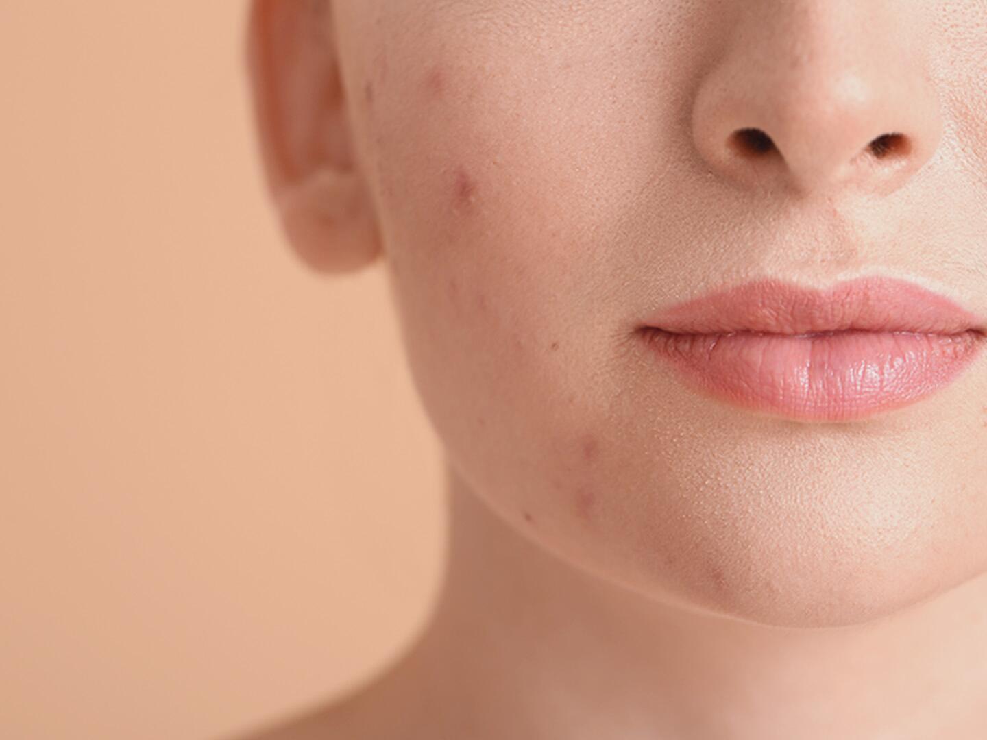 Die verschiedenen Akne Arten Eau Thermale Avène