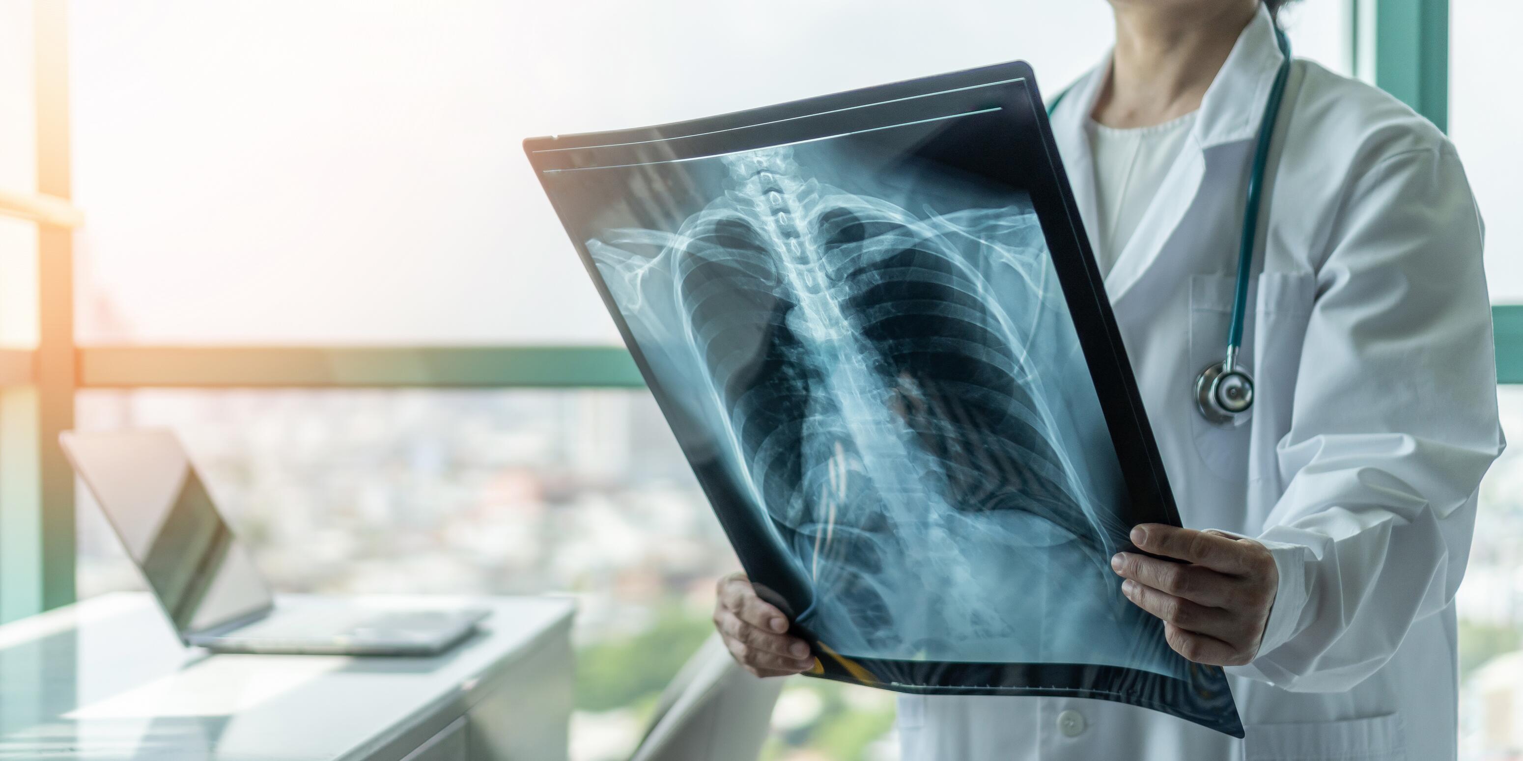 OG_DOCTOR_LOOKING_XRAY_LUNG_CANCER_ISTOCK_2021